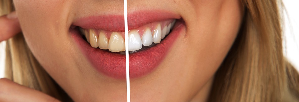Why Are Custom Whitening Trays Better than Strips?