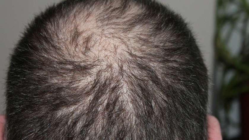 Top 2 Non-Surgical Methods in Solving Hair Loss